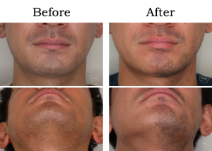 Read more about the article 【Mela-Clear】ひげ脱毛 Aさん