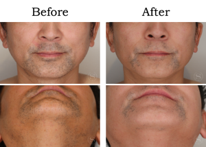 Read more about the article 【Mela-Clear】ひげ脱毛 Kさん