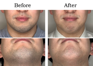 Read more about the article 【Mela-Clear】ひげ脱毛 Oさん