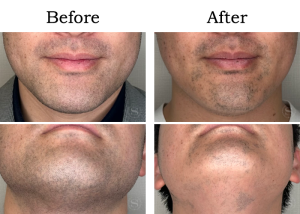 Read more about the article 【Mela-Clear】ひげ脱毛 Wさん