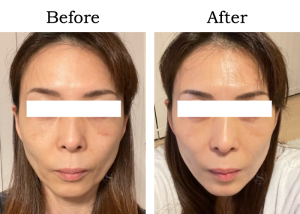 Read more about the article 【Mela-Clear】エイジング Mさん 50代