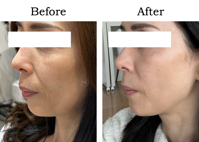 エイジング-Mさん-55歳-横