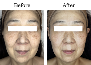 Read more about the article 【Mela-Clear】エイジングくすみ Aさん 50代