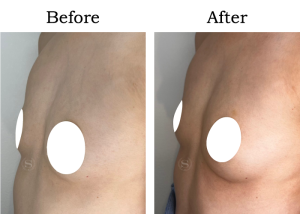 Read more about the article 【Mela-Clear】サイズアップ Sさん 30代