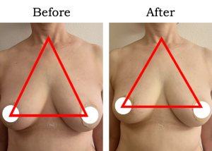 Read more about the article 【Mela-Clear】バストアップ Kさん 40代