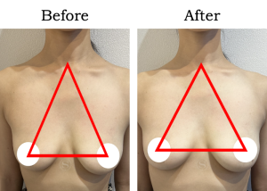 Read more about the article 【Mela-Clear】バストアップ Sさん 30代