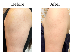 Read more about the article 【Mela-Clear】ボディケア Mさん 40代