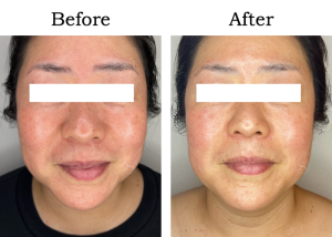 Read more about the article 【Mela-Clear】美白 Mさん 40代