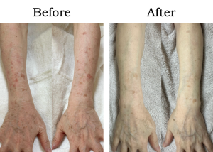 Read more about the article 【Mela-Clear】腕美白 Kさん 60代